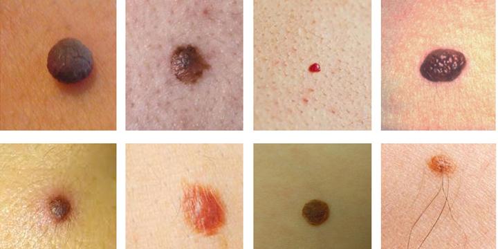 Nốt ruồi có lông là tốt hay xấu? | Tử Vi Cổ Học